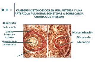 Hipertrofia de la media lámina interna y externa Fibrosis de la adventicia Muscularización Fibrosis de adventicia CAMBIOS HISTOLOGICOS EN UNA ARTERIA Y UNA ARTERIOLA PULMONAR SOMETIDAS A SOBRECARGA CRONICA DE PRESION 