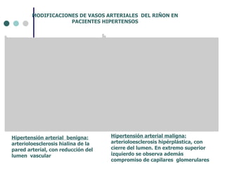 MODIFICACIONES DE VASOS ARTERIALES  DEL RIÑON EN PACIENTES HIPERTENSOS Hipertensión arterial  benigna:  arterioloesclerosis hialina de la pared arterial, con reducción del lumen  vascular Hipertensión arterial maligna:  arterioloesclerosis hipérplástica, con cierre del lumen. En extremo superior izquierdo se observa además compromiso de capilares  glomerulares 