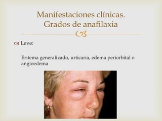Manifestaciones clínicas.
           Grados de anafilaxia
                          
 Leve:

  Eritema generalizado, urticaria, edema periorbital o
  angioedema
 