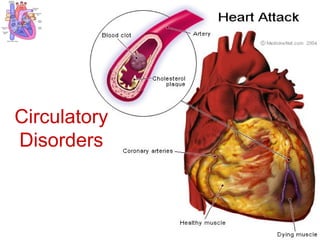 Circulatory Disorders 