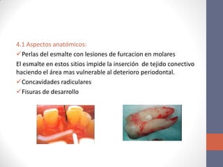 4.1 Aspectos anatómicos:
Perlas del esmalte con lesiones de furcacion en molares
El esmalte en estos sitios impide la inserción de tejido conectivo
haciendo el área mas vulnerable al deterioro periodontal.
Concavidades radiculares
Fisuras de desarrollo
 