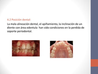 4.2 Posición dental:
La mala alineación dental, el apiñamiento, la inclinación de un
diente con área edentula han sido condiciones en la perdida de
soporte periodontal.
 