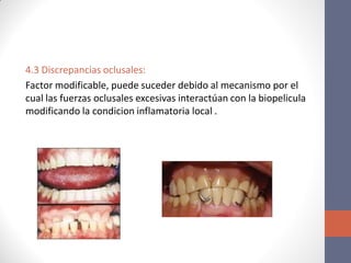 4.3 Discrepancias oclusales:
Factor modificable, puede suceder debido al mecanismo por el
cual las fuerzas oclusales excesivas interactúan con la biopelicula
modificando la condicion inflamatoria local .
 
