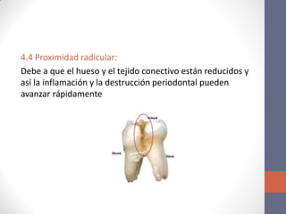 4.4 Proximidad radicular:
Debe a que el hueso y el tejido conectivo están reducidos y
así la inflamación y la destrucción periodontal pueden
avanzar rápidamente
 
