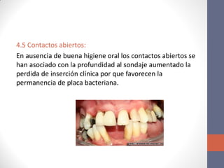 4.5 Contactos abiertos:
En ausencia de buena higiene oral los contactos abiertos se
han asociado con la profundidad al sondaje aumentado la
perdida de inserción clínica por que favorecen la
permanencia de placa bacteriana.
 