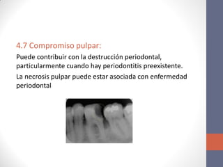 4.7 Compromiso pulpar:
Puede contribuir con la destrucción periodontal,
particularmente cuando hay periodontitis preexistente.
La necrosis pulpar puede estar asociada con enfermedad
periodontal
 