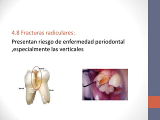 4.8 Fracturas radiculares:
Presentan riesgo de enfermedad periodontal
,especialmente las verticales
 