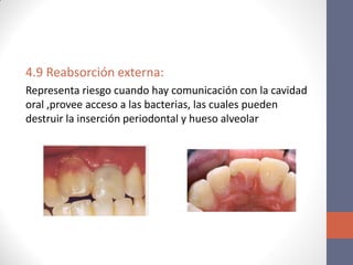 4.9 Reabsorción externa:
Representa riesgo cuando hay comunicación con la cavidad
oral ,provee acceso a las bacterias, las cuales pueden
destruir la inserción periodontal y hueso alveolar
 