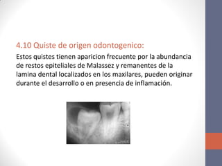 4.10 Quiste de origen odontogenico:
Estos quistes tienen aparicion frecuente por la abundancia
de restos epiteliales de Malassez y remanentes de la
lamina dental localizados en los maxilares, pueden originar
durante el desarrollo o en presencia de inflamación.
 