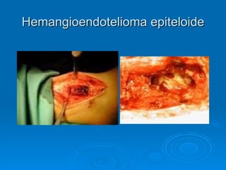 Hemangioendotelioma epiteloide