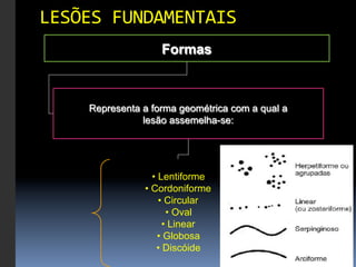 LESÕES	
  FUNDAMENTAIS	
  
                     Formas



      Representa a forma geométrica com a qual a
                 lesão assemelha-se:




                    •  Lentiforme
                 •  Cordoniforme
                       •  Circular
                          •  Oval
                        •  Linear
                      •  Globosa
                      •  Discóide
 