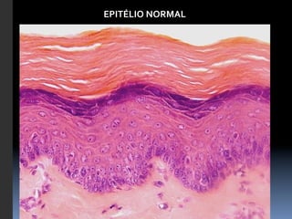EPITÉLIO	
  NORMAL	
  


EPITÉLIO	
  NORMAL	
  
 