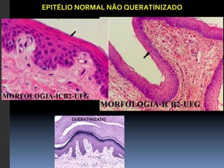 EPITÉLIO	
  NORMAL	
  NÃO	
  QUERATINIZADO	
  




         QUERATINIZADO	
  
 