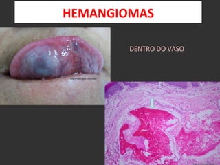 HEMANGIOMAS	
  

          DENTRO	
  DO	
  VASO	
  
 