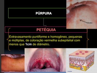 PÚRPURA




                   PETÉQUIA
Extravasamento puntiforme e homogêneo, pequenas
e múltiplas, de coloração vermelha subepitelial com
menos que 1cm de diâmetro.
 