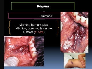 Púrpura


               Equimose

   Mancha hemorrágica
idêntica, porém o tamanho
      é maior (> 1cm).
 