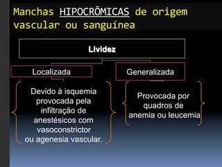 Manchas	
  HIPOCRÔMICAS	
  de	
  origem	
  
vascular	
  ou	
  sanguínea	
  

                   Lividez

    Localizada               Generalizada

   Devido à isquemia
                               Provocada por
     provocada pela
                                quadros de
      infiltração de
                             anemia ou leucemia
    anestésicos com
     vasoconstrictor
  ou agenesia vascular.
 