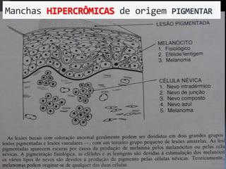 Manchas	
  HIPERCRÔMICAS	
  de	
  origem	
  PIGMENTAR	
  
 