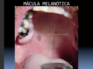 MÁCULA	
  MELANÓTICA
                   	
  
 