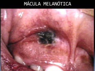 MÁCULA	
  MELANÓTICA
                   	
  
 