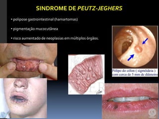 SINDROME	
  DE	
  PEUTZ-­‐JEGHERS	
  	
  
• 	
  polipose	
  gastrointestinal	
  (hamartomas)	
  

• 	
  pigmentação	
  mucocutânea	
  

• 	
  risco	
  aumentado	
  de	
  neoplasias	
  em	
  múltiplos	
  órgãos.	
  
 