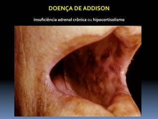 DOENÇA	
  DE	
  ADDISON	
  
                              	
  
insuﬁciência	
  adrenal	
  crônica	
  ou	
  hipocortisolismo	
  	
  
 