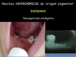 Manchas	
  HIPERCRÔMICAS	
  de	
  origem	
  pigmentar	
  

                      EXÓGENAS	
  
                             	
  
                Tatuagem	
  por	
  amálgama	
  
 