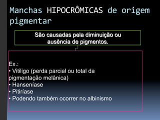 Manchas	
  HIPOCRÔMICAS	
  de	
  origem	
  
pigmentar	
  
         São causadas pela diminuição ou
             ausência de pigmentos.


Ex.:
•  Vitiligo (perda parcial ou total da
pigmentação melânica)
•  Hanseníase
•  Pitiríase
•  Podendo também ocorrer no albinismo
 