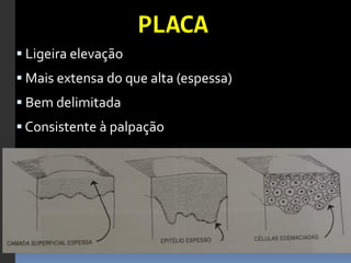 PLACA	
  
§ 	
  Ligeira	
  elevação	
  	
  
§ 	
  Mais	
  extensa	
  do	
  que	
  alta	
  (espessa)	
  
§ 	
  Bem	
  delimitada	
  
§ 	
  Consistente	
  à	
  palpação	
  
	
  
 