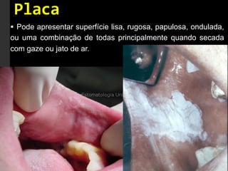 Placa	
  
§  Pode apresentar superfície lisa, rugosa, papulosa, ondulada,
ou uma combinação de todas principalmente quando secada
com gaze ou jato de ar.
 