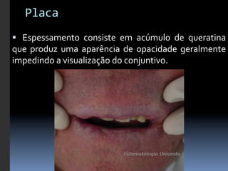 Placa	
  
§  	
   Espessamento	
   consiste	
   em	
   acúmulo	
   de	
   queratina	
  
que	
   produz	
   uma	
   aparência	
   de	
   opacidade	
   geralmente	
  
impedindo	
  a	
  visualização	
  do	
  conjuntivo.	
  	
  
 