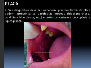 PLACA	
  
§  	
   Seu	
   diagnóstico	
   deve	
   ser	
   cuidadoso,	
   pois	
   em	
   forma	
   de	
   placa	
  
podem	
   apresentar-­‐se	
   patologias	
   inócuas	
   (hiperqueratose,	
  
candidíase	
   hiperplásica,	
   etc.)	
   e	
   lesões	
   cancerizáveis	
   (leucoplasia	
   e	
  
líquen	
  plano).	
  
 