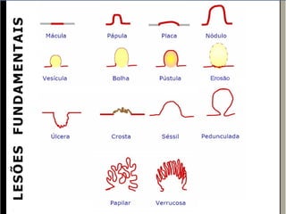 LESÕES FUNDAMENTAIS
 