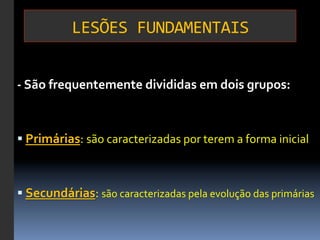 LESÕES	
  FUNDAMENTAIS
                                     	
  


-­‐	
  São	
  frequentemente	
  divididas	
  em	
  dois	
  grupos:	
  	
  

	
  

§ 	
  Primárias:	
  são	
  caracterizadas	
  por	
  terem	
  a	
  forma	
  inicial	
  



§ 	
  Secundárias:	
  são	
  caracterizadas	
  pela	
  evolução	
  das	
  primárias	
  
 