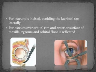  Periosteum is incised, avoiding the lacrimal sac
laterally
 Periosteum over orbital rim and anterior surface of
maxilla, zygoma and orbital floor is reflected
 