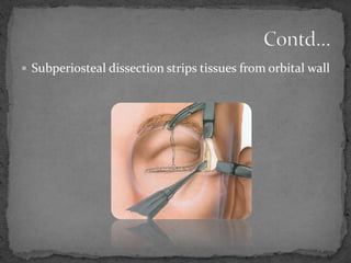  Subperiosteal dissection strips tissues from orbital wall
 