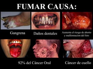 FUMAR CAUSA:


Gangrena                     Aumenta el riesgo de aborto
            Daños dentales    y malformacion del feto




    92% del Cáncer Oral        Cáncer de cuello
 