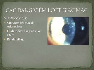 VLGM do virus:
 Sau viêm kết mạc do
Adenovirus
 Hình thái: viêm giác mạc
chấm
 Rất dai dẳng
 
