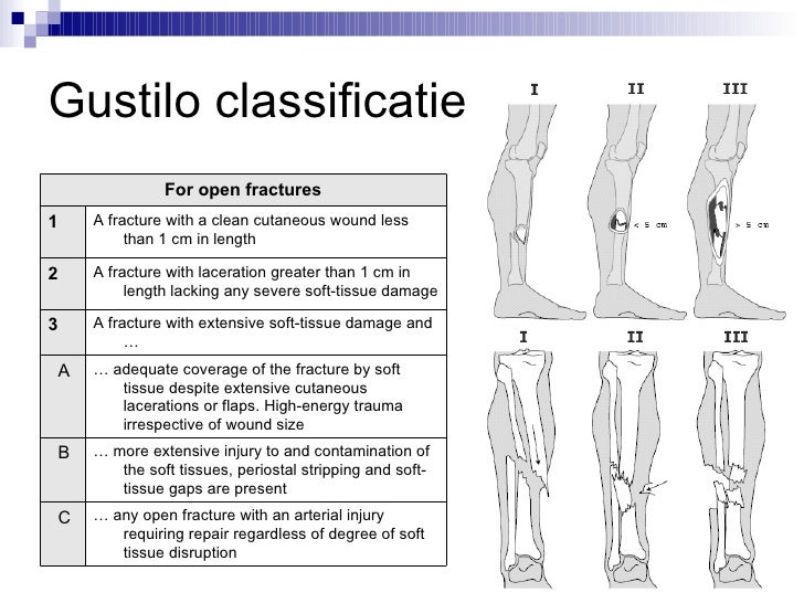 Gustilo Fracture Classification PDLMJ Gustilo Fracture Classification PDLMJ