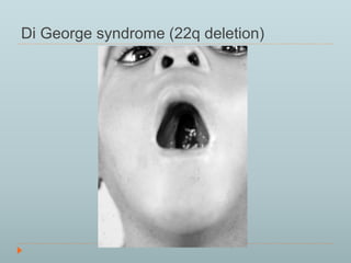 Di George syndrome (22q deletion) 
 