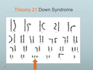 Trisomy 21 Down Syndrome 
 