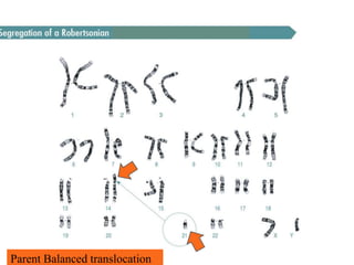 Parent Balanced translocation 
 