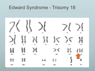 Edward Syndrome - Trisomy 18 
 