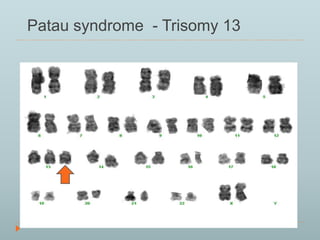 Patau syndrome - Trisomy 13 
 