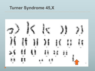 Turner Syndrome 45,X 
 