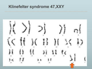 Klinefelter syndrome 47,XXY 
 