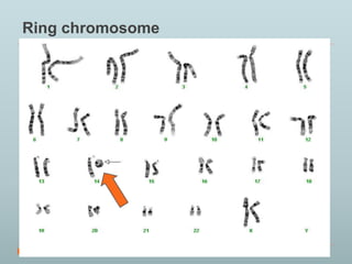 Ring chromosome 
 
