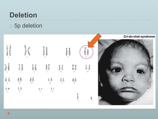 Deletion 
5p deletion 
 