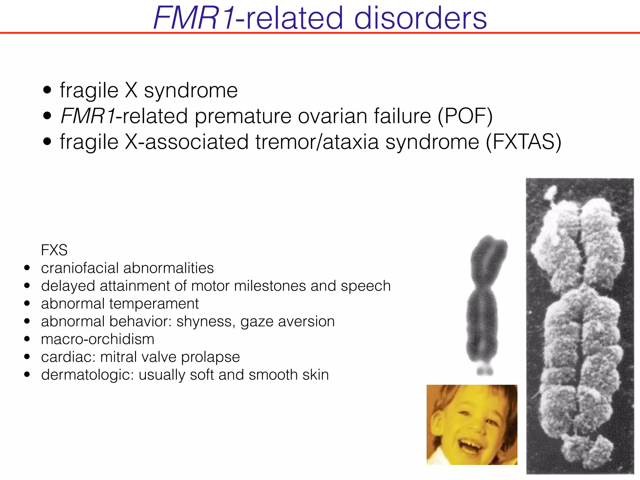 • fragile X syndrome
• FMR1-related premature ovarian failure (POF)
• fragile X-associated tremor/ataxia syndrome (FXTAS)
FXS
• craniofacial abnormalities
• delayed attainment of motor milestones and speech
• abnormal temperament
• abnormal behavior: shyness, gaze aversion
• macro-orchidism
• cardiac: mitral valve prolapse
• dermatologic: usually soft and smooth skin
FMR1-related disorders
 