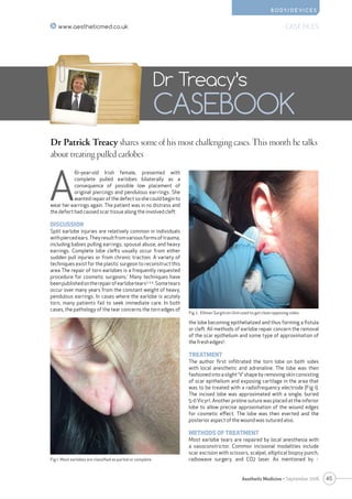 45Aesthetic Medicine • September 2016
Dr Patrick Treacy shares some of his most challenging cases. This month he talks
about treating pulled earlobes
Dr Treacy’s
CASEBOOK
A
61-year-old Irish female, presented with
complete pulled earlobes bilaterally as a
consequence of possible low placement of
original piercings and pendulous ear-rings. She
wanted repair of the defect so she could begin to
wear her earrings again. The patient was in no distress and
the defect had caused scar tissue along the involved cleft.
DISCUSSION
Split earlobe injuries are relatively common in individuals
withpiercedears.Theyresultfromvariousformsoftrauma,
including babies pulling earrings, spousal abuse, and heavy
earrings. Complete lobe clefts usually occur from either
sudden pull injuries or from chronic traction. A variety of
techniques exist for the plastic surgeon to reconstruct this
area The repair of torn earlobes is a frequently requested
procedure for cosmetic surgeons.1
Many techniques have
beenpublishedontherepairofearlobetears2,3,4
.Sometears
occur over many years from the constant weight of heavy,
pendulous earrings. In cases where the earlobe is acutely
torn, many patients fail to seek immediate care. In both
cases, the pathology of the tear concerns the torn edges of
the lobe becoming epithelialized and thus forming a fistula
or cleft. All methods of earlobe repair concern the removal
of the scar epithelium and some type of approximation of
the fresh edges5
.
TREATMENT
The author first infiltrated the torn lobe on both sides
with local anesthetic and adrenaline. The lobe was then
fashioned into a slight ‘V’ shape by removing skin consisting
of scar epithelium and exposing cartilage in the area that
was to be treated with a radiofrequency electrode (Fig 1).
The incised lobe was approximated with a single, buried
5-0 Vicyrl. Another proline suture was placed at the inferior
lobe to allow precise approximation of the wound edges
for cosmetic effect. The lobe was then everted and the
posterior aspect of the wound was sutured also.
METHODS OF TREATMENT
Most earlobe tears are repaired by local anesthesia with
a vasoconstrictor. Common incisional modalities include
scar excision with scissors, scalpel, elliptical biopsy punch,
radiowave surgery, and CO2 laser. As mentioned by >
CASE FILESwww.aestheticmed.co.uk
B O D Y/ D E V I C E S
Fig 1. Most earlobes are classified as partial or complete
Fig 2. Ellman Surgitron Unit used to get clean opposing sides
 